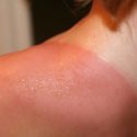 The Best Natural Remedy for Your Sunburn